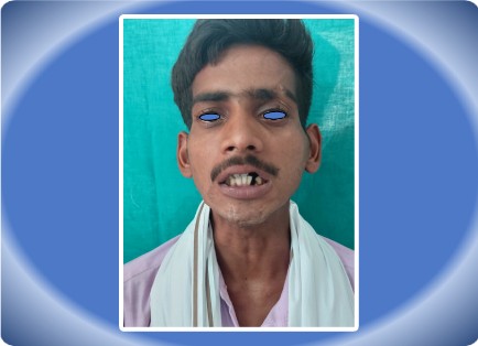 TEMPOROMANDIBULAR ANKYLOSIS